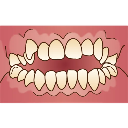 orthodontics032 不正咬合(開口)