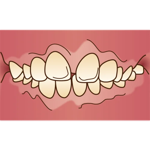 orthodontics036 不正咬合