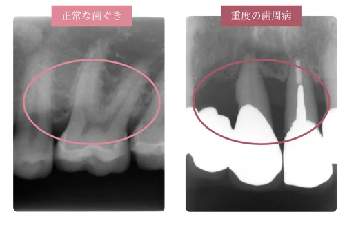 歯周病の診査・診断