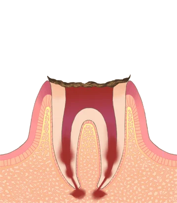5.png 歯冠を失った歯のイラスト