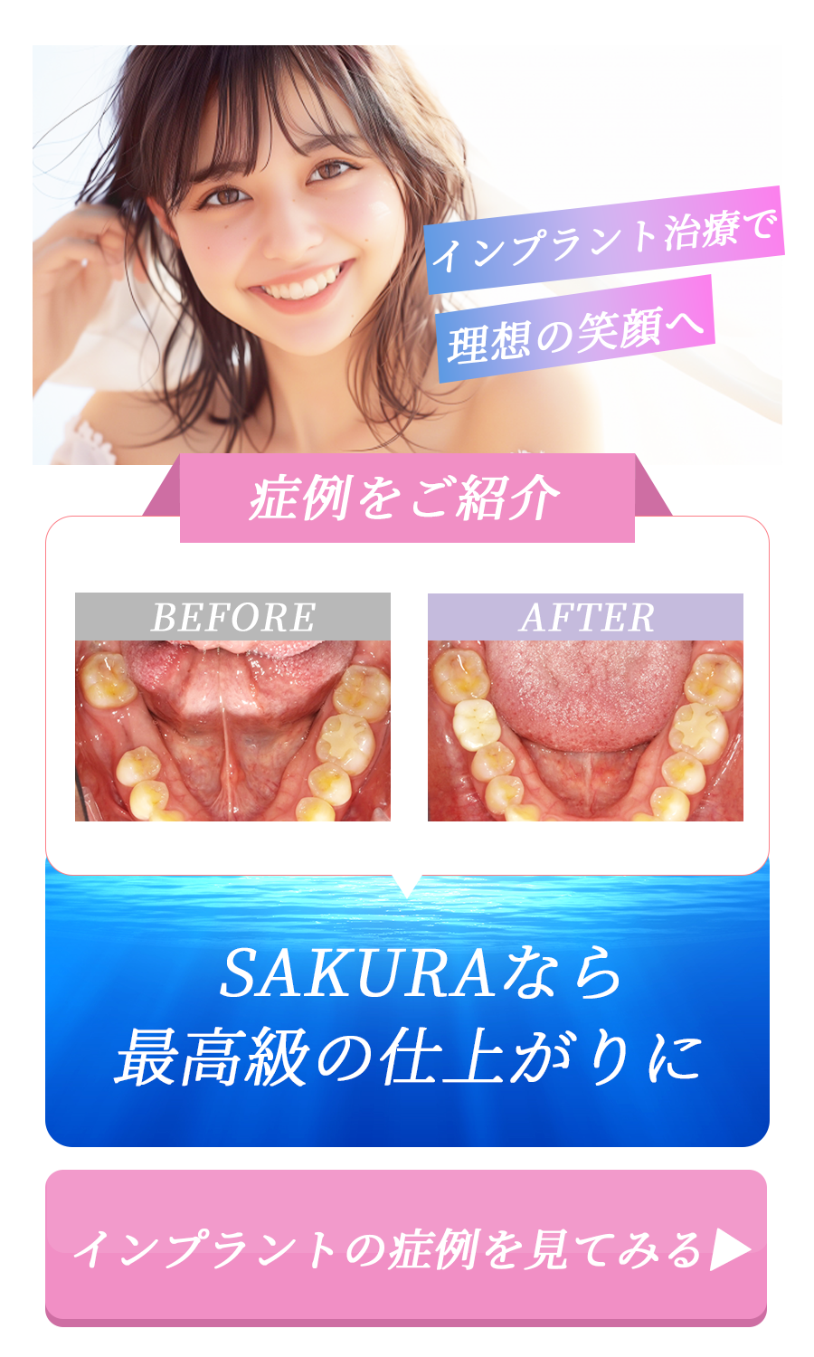 インプラント症例ポップアップ
