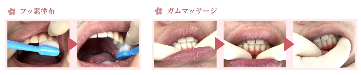 フッ素塗布・仕上げ