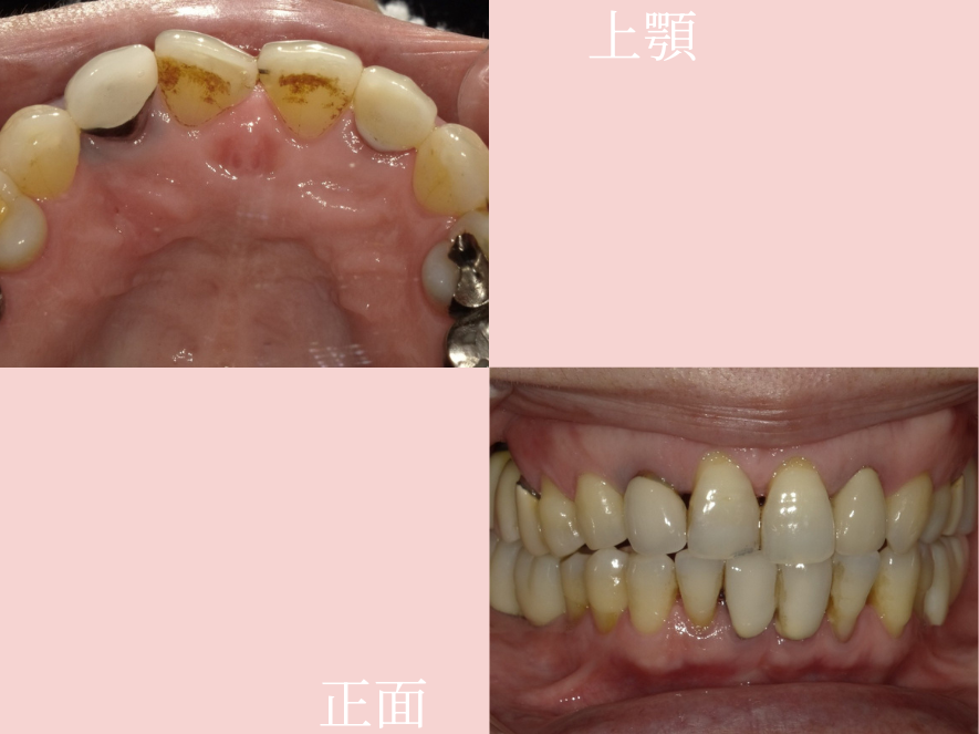 Before