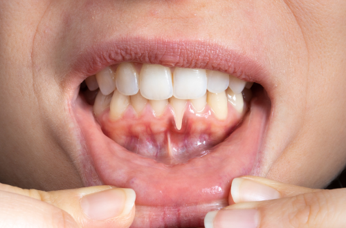 歯周病のイメージ