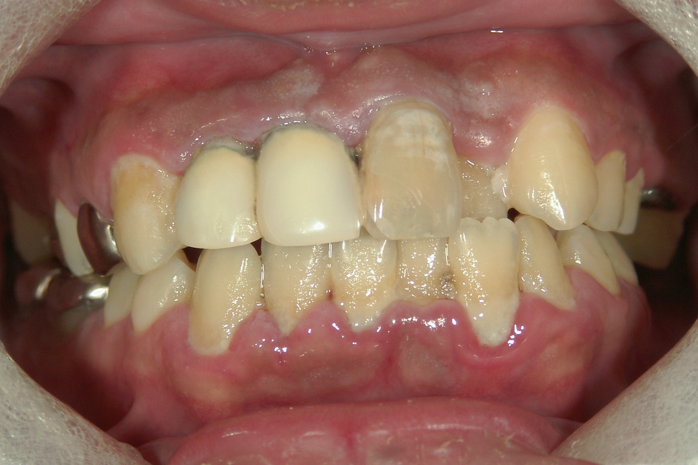 中等度歯周病の例