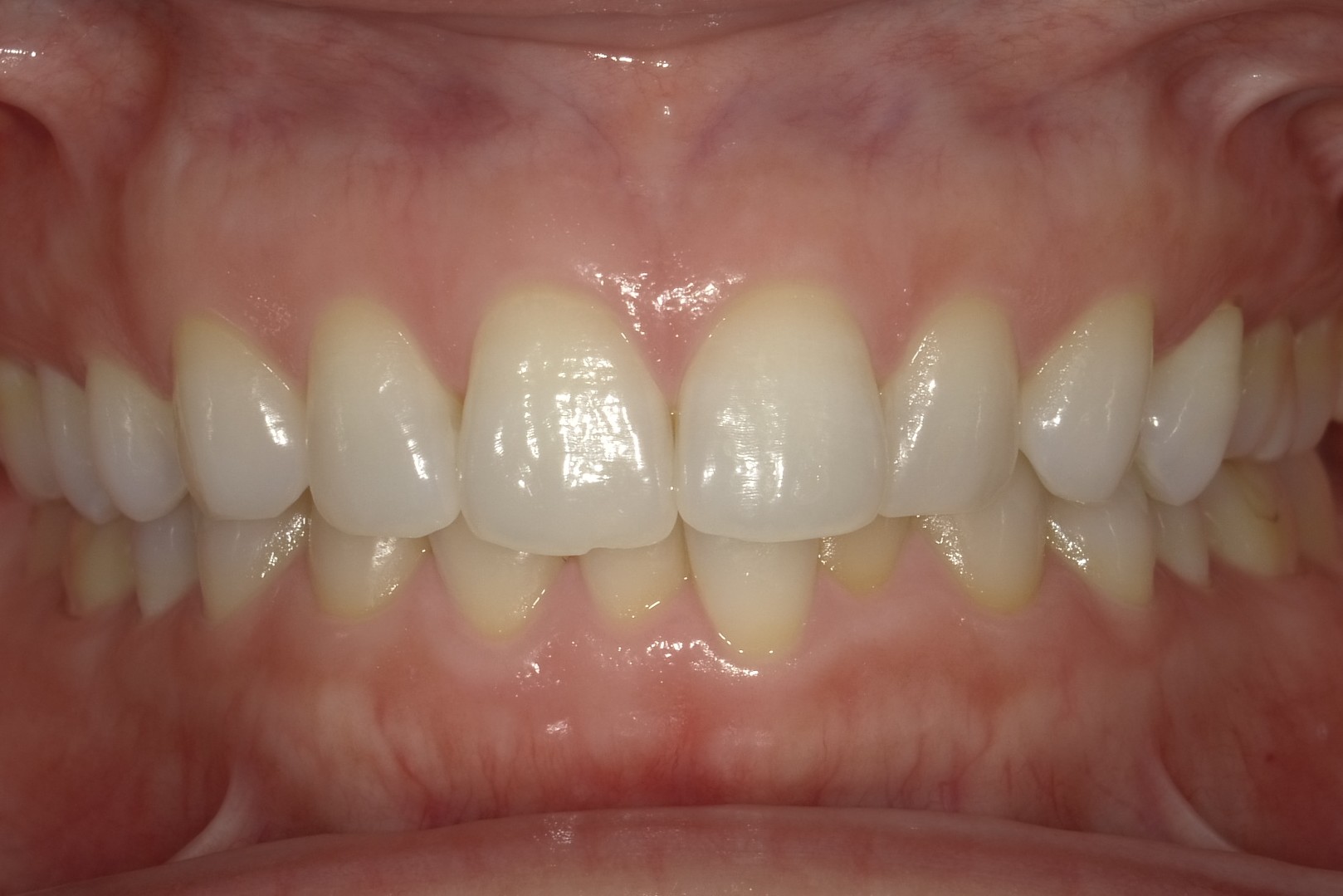 正常な歯ぐきの例