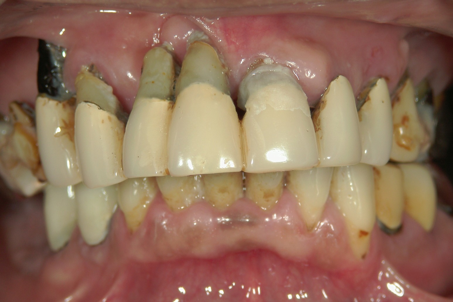 重度歯周病の例