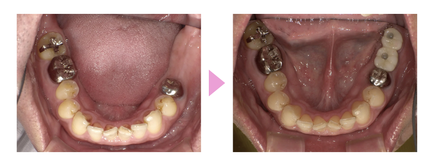 インプラントの症例