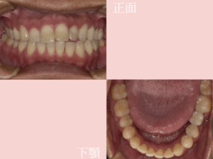 ジルコニアインプラント治療後